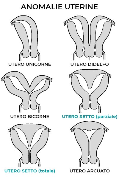 anomalie uterine - utero setto