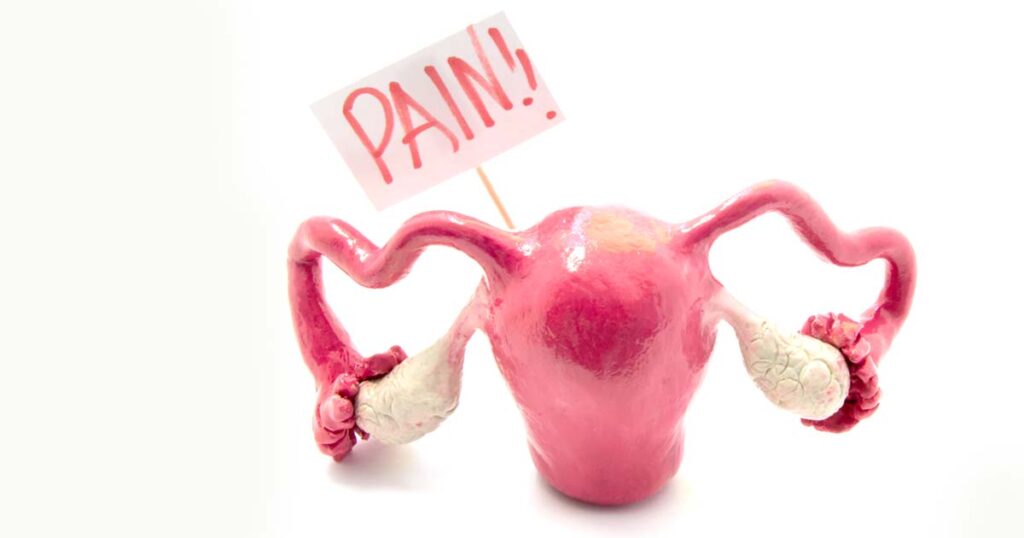 endometriosi